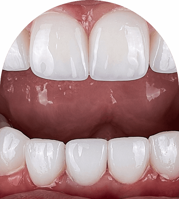 Composite Bonding