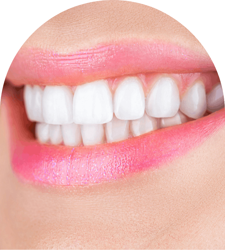 Teeth Whitening