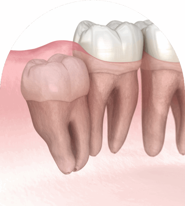Tooth Extraction