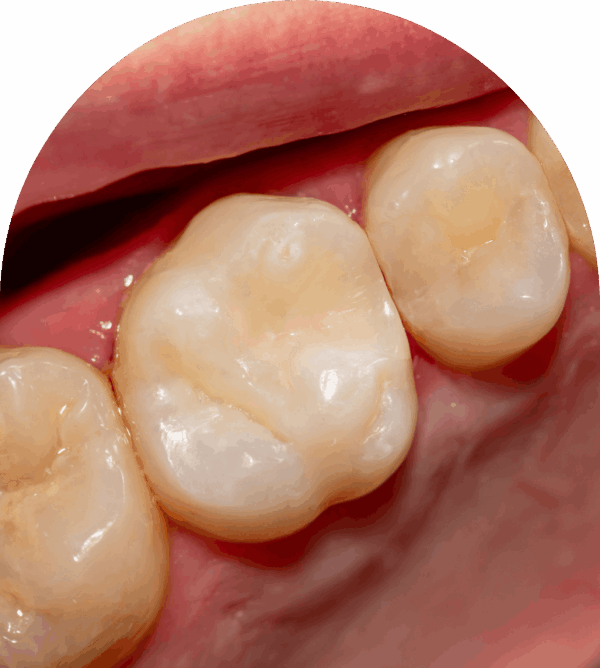 Tooth-coloured Fillings