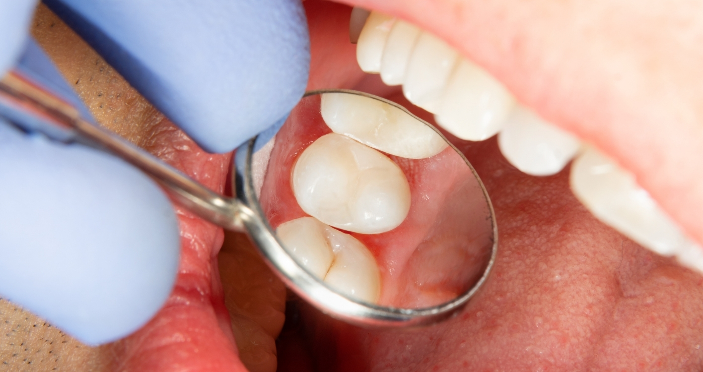 Tooth-coloured Fillings Tooth-coloured Fillings