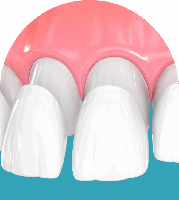 Veneers