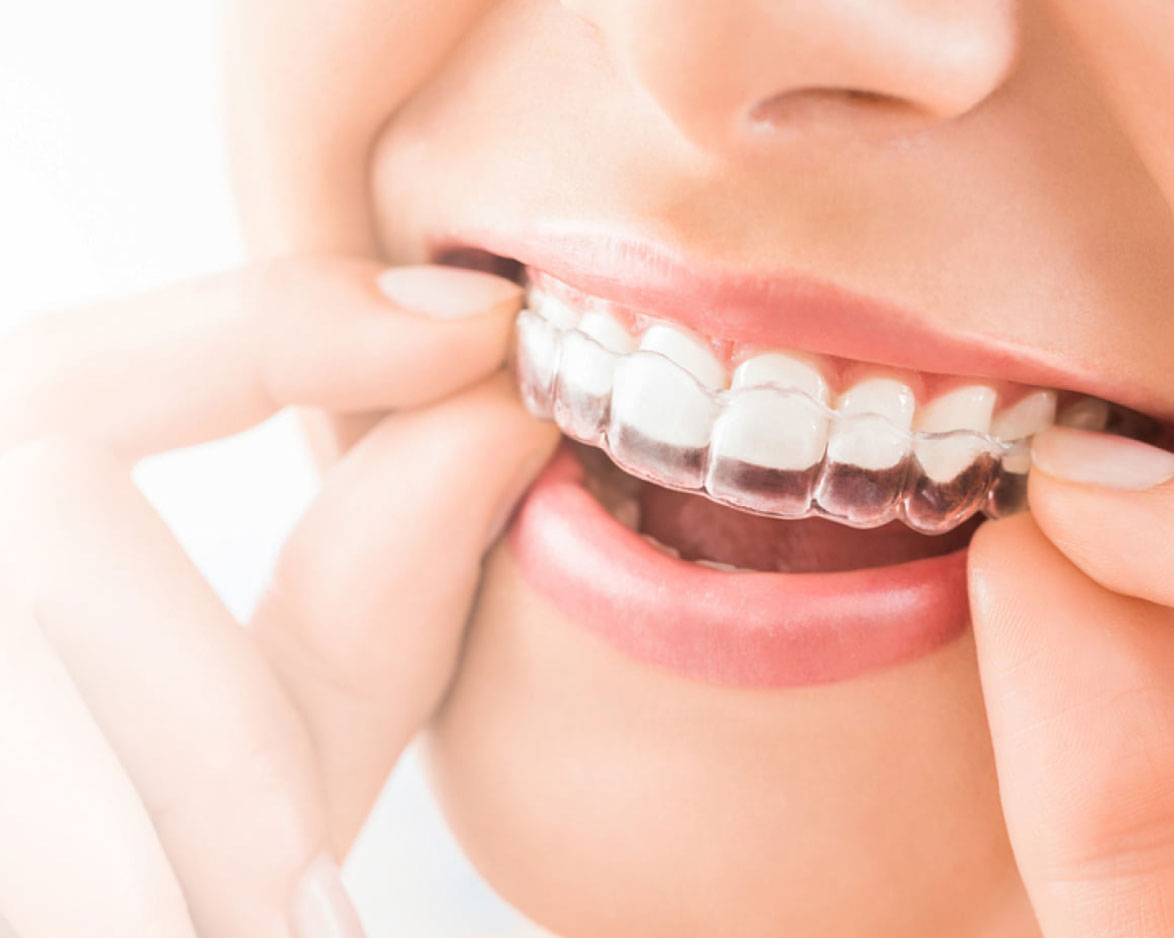 Invisalign